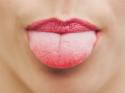 Lưỡi bợn trắng và nhám lưỡi là dấu hiệu bệnh gì ?
