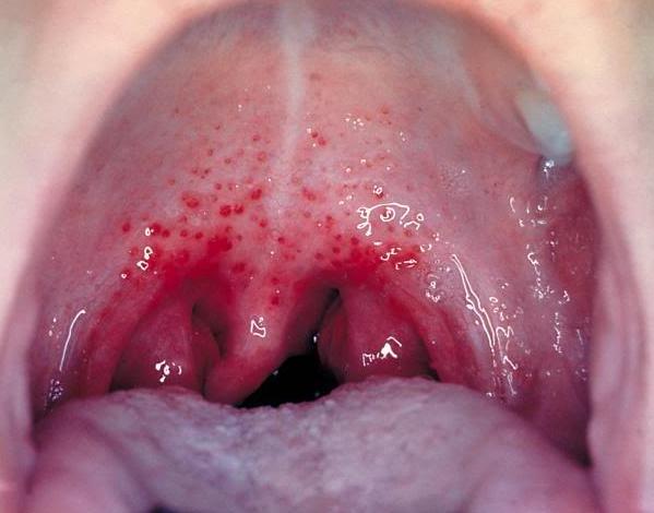 Phân biệt viêm họng hạt và ung thư vòm họng