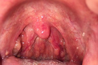 Viêm họng hạt gây nhiều triệu chứng khó chịu, ảnh hưởng đến sức khỏe và sịnh hoạt