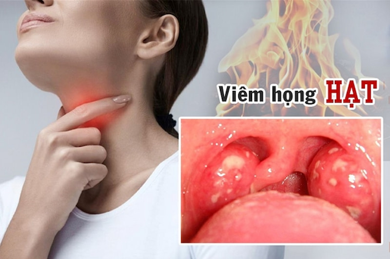 Viêm họng hạt tiềm ẩn nhiều nguy cơ gây biến chứng